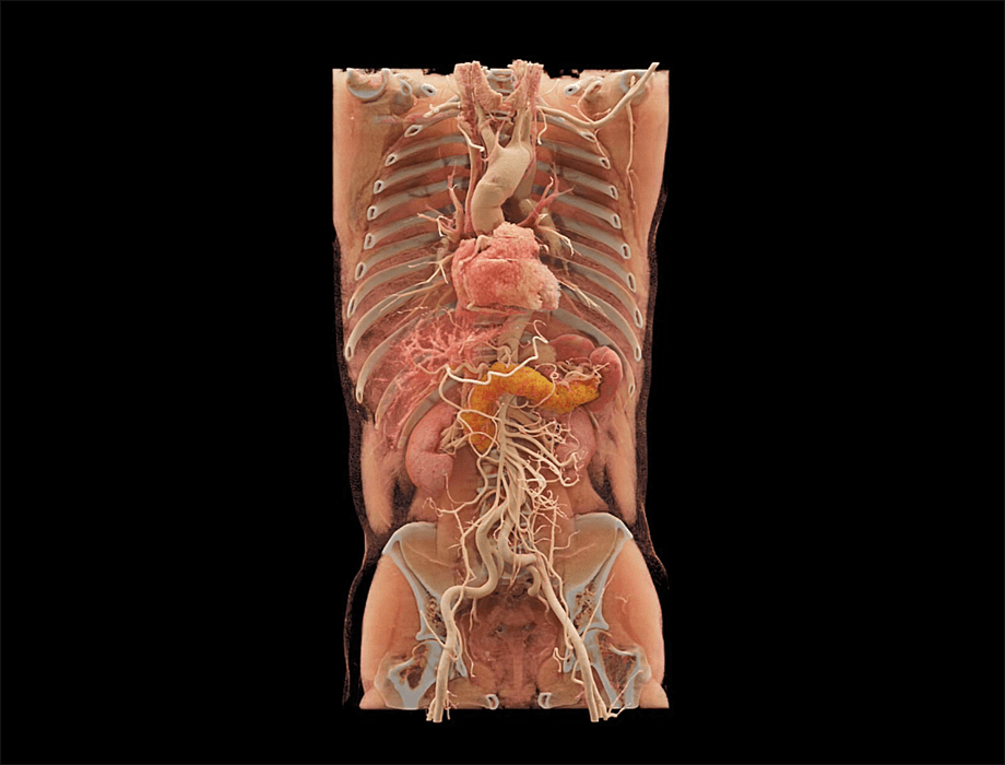 CT_HeadNeck_HeartVessel_Review_Coronal_0 00_00_00-00_00_30