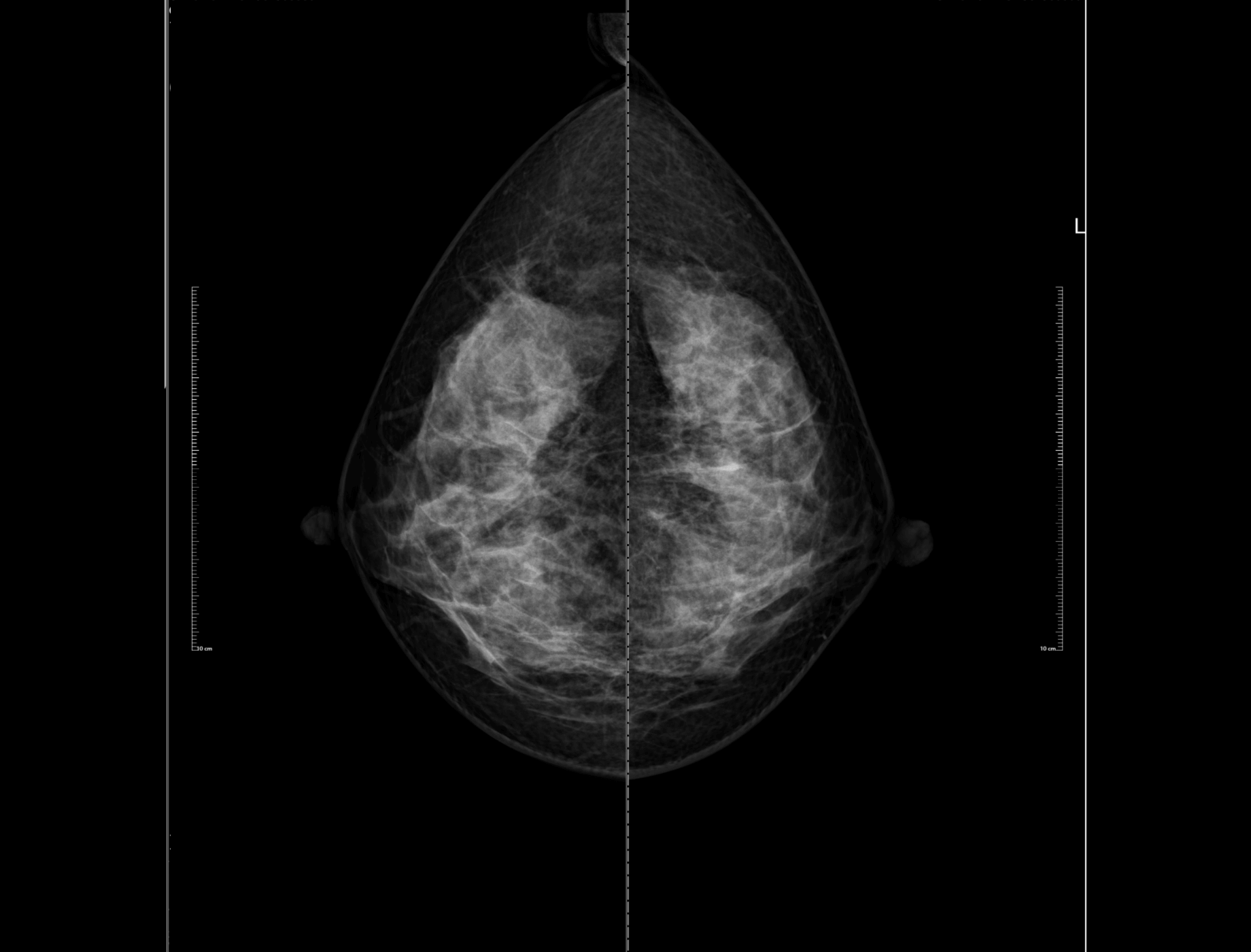 software_breast1-new