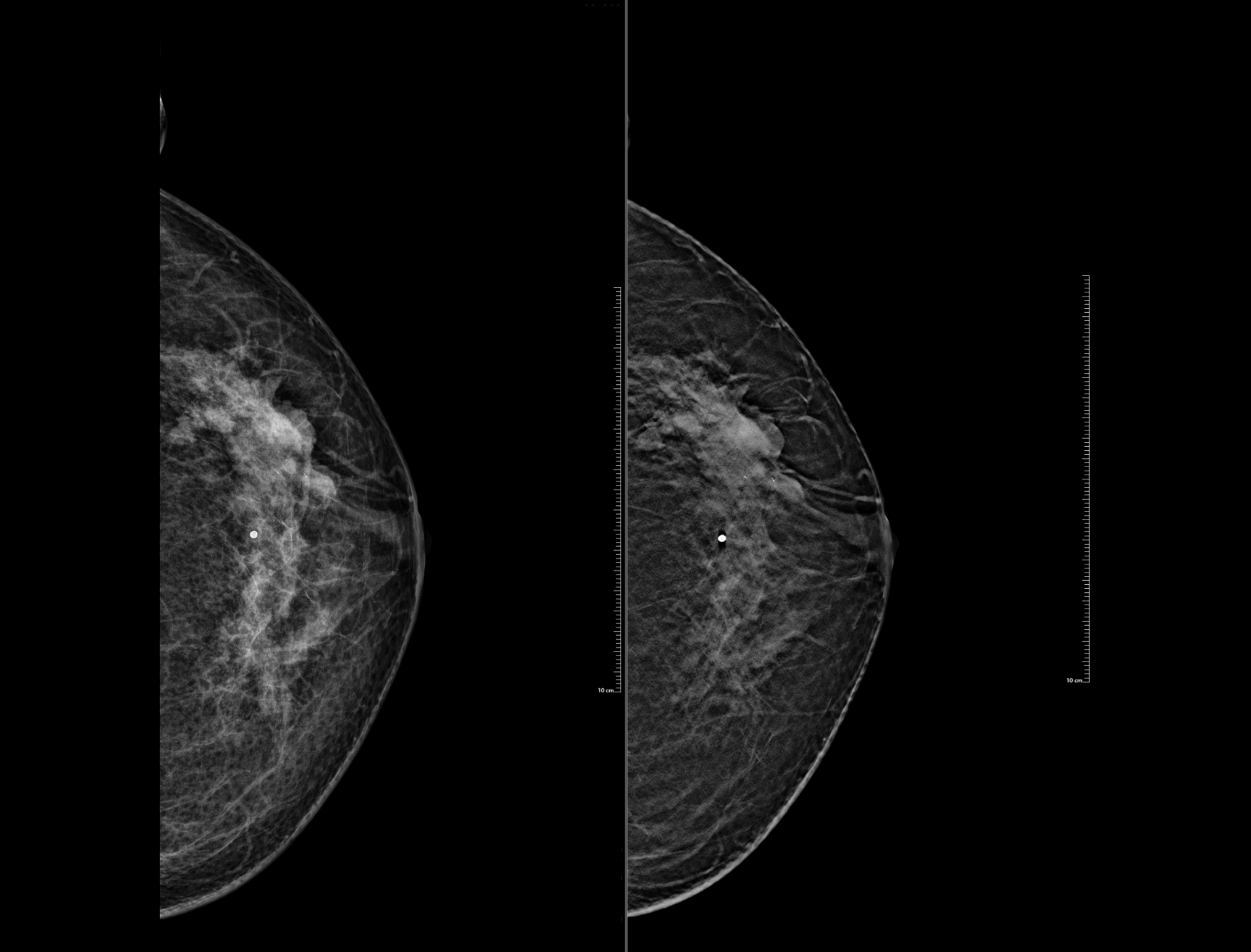 software_breast2-new