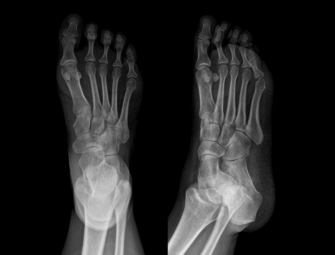 Widok przednio-tylny i skośny przednio-tylny stopy