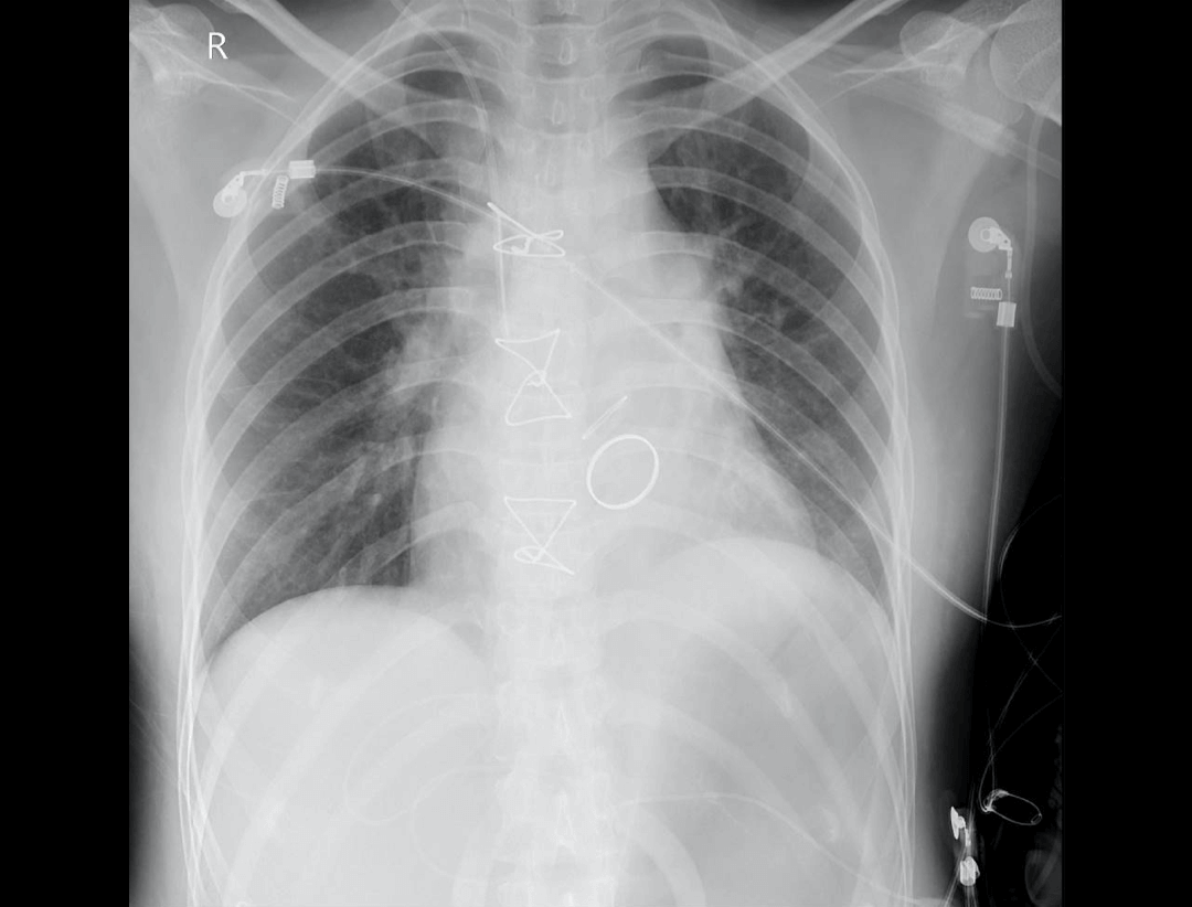 Widok przednio-tylny klatki piersiowej