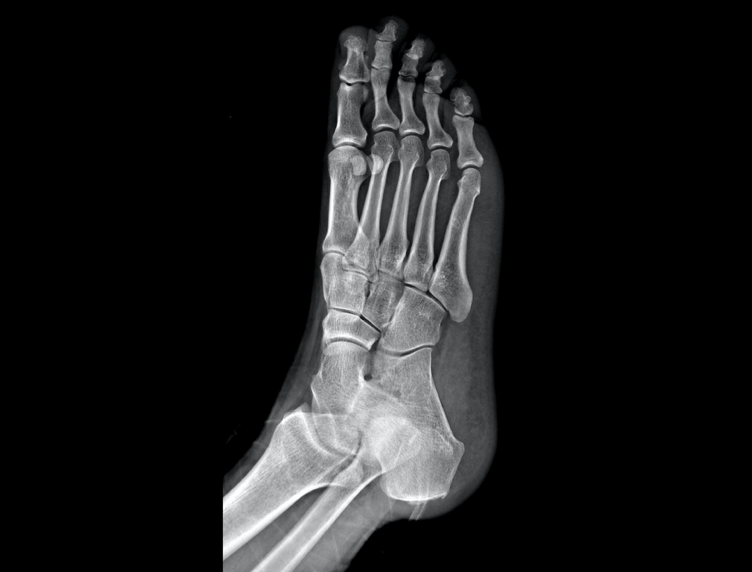 Widok skośny przednio-tylny stopy