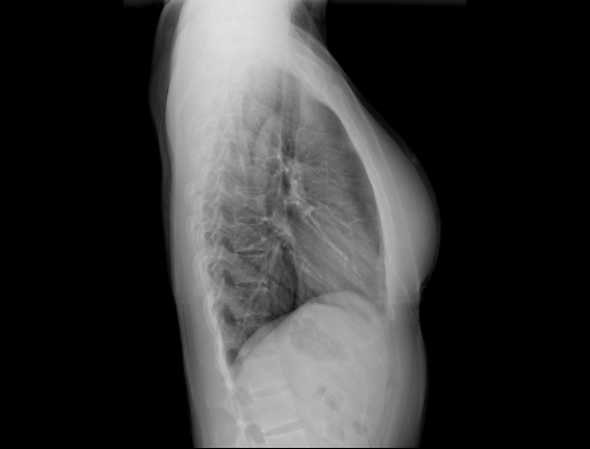 a chest x-ray PA projection