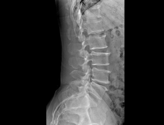 lumbar spine in lateral position