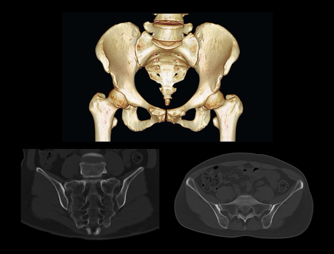 Sacroiliac Joint Scan