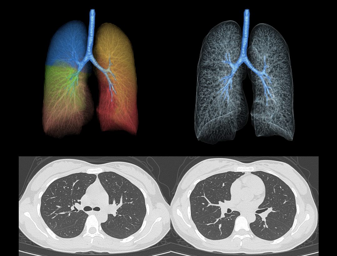 Non-contrast Chest Scan