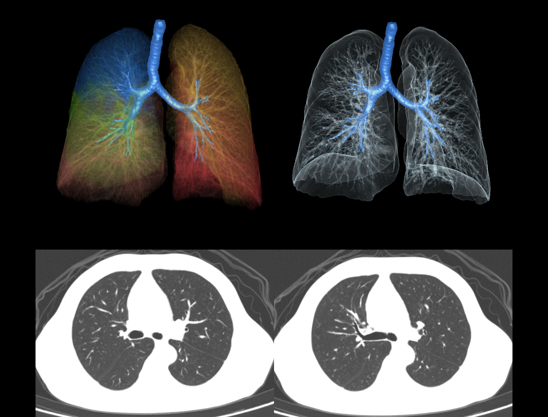 Non-contrast Chest Scan