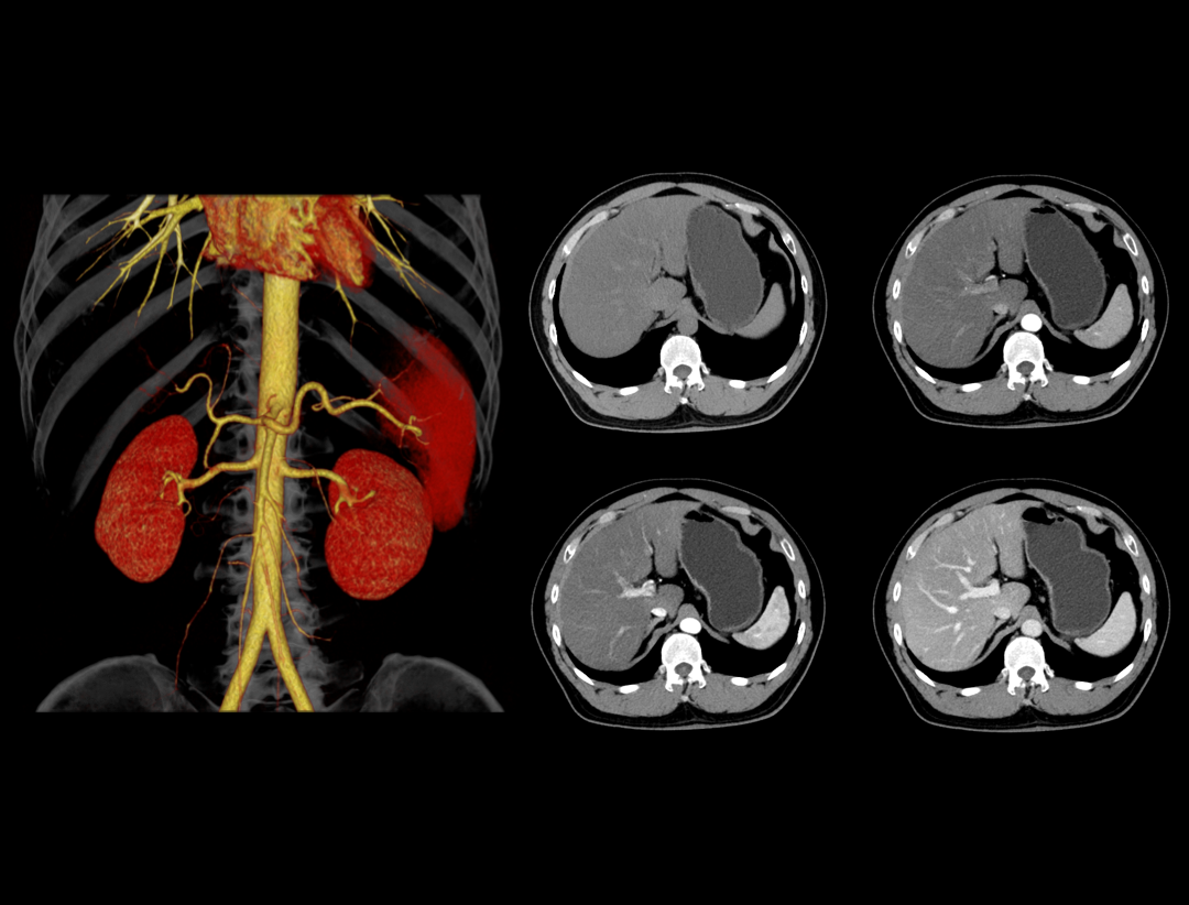 Contrast Enhanced Abdomen Scan