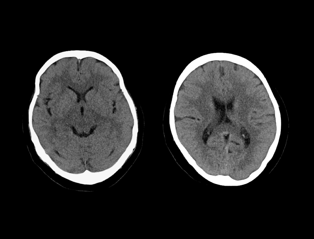 Non-contrast Head Scan