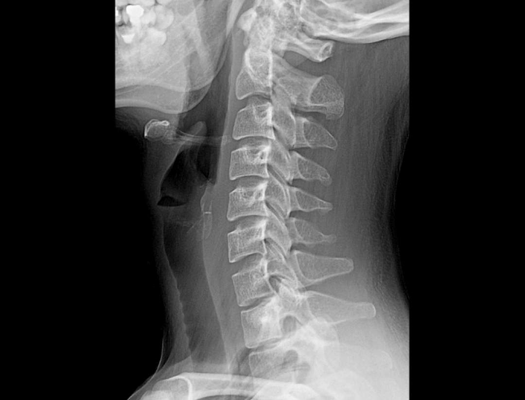 Widok boczny kręgów szyjnych