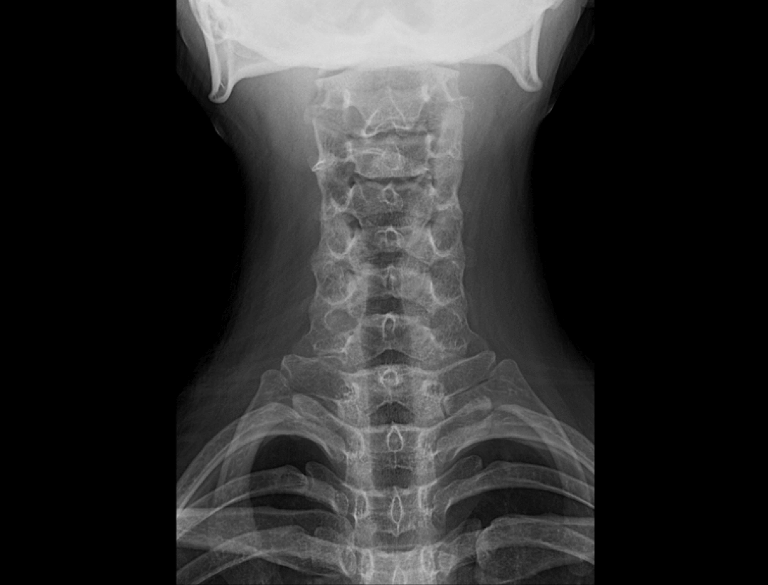 Widok przednio-tylny kręgosłupa szyjnego