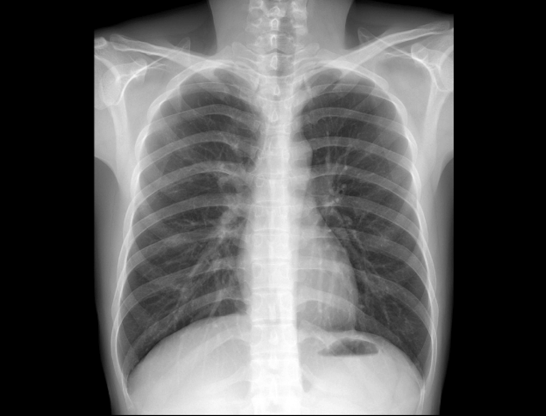 Widok przednio-tylny klatki piersiowej