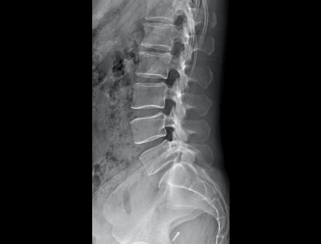 Lumbar Vertebrae LAT
