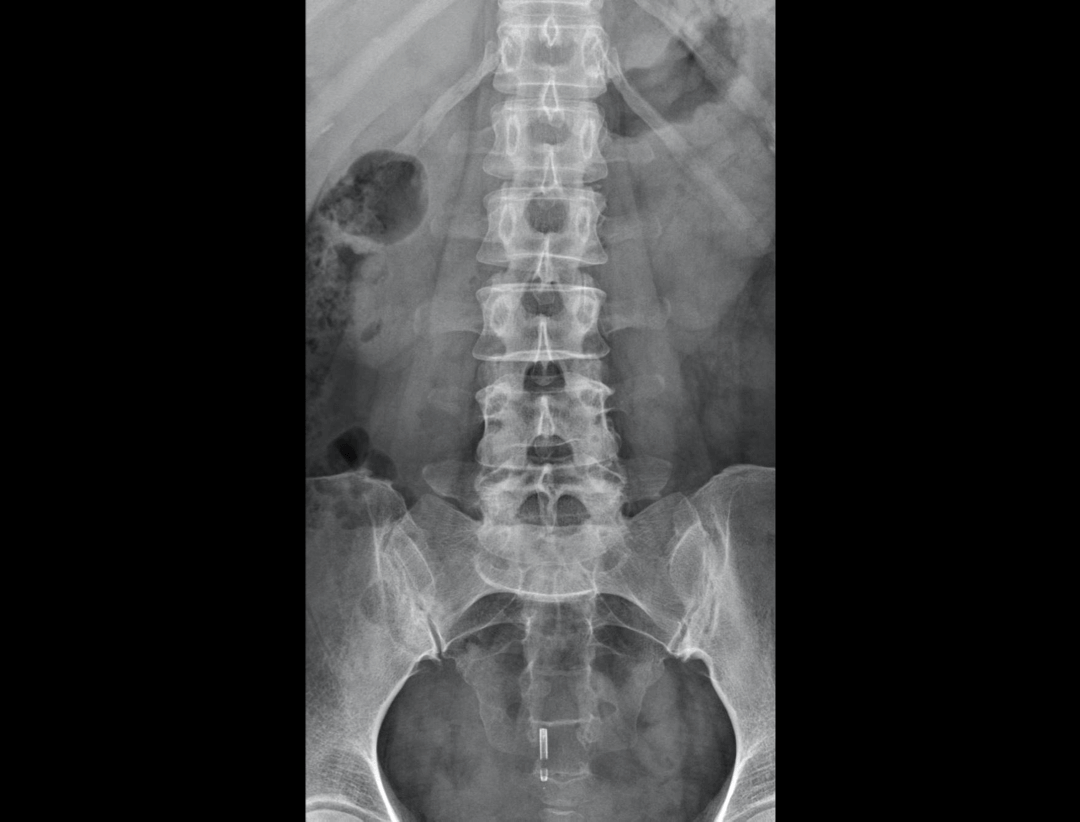 Lumbar Vertebrae AP