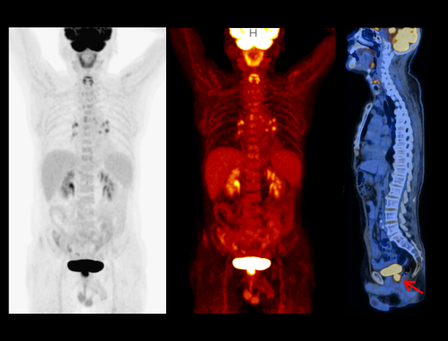 uMI  550_Rectal Cancer