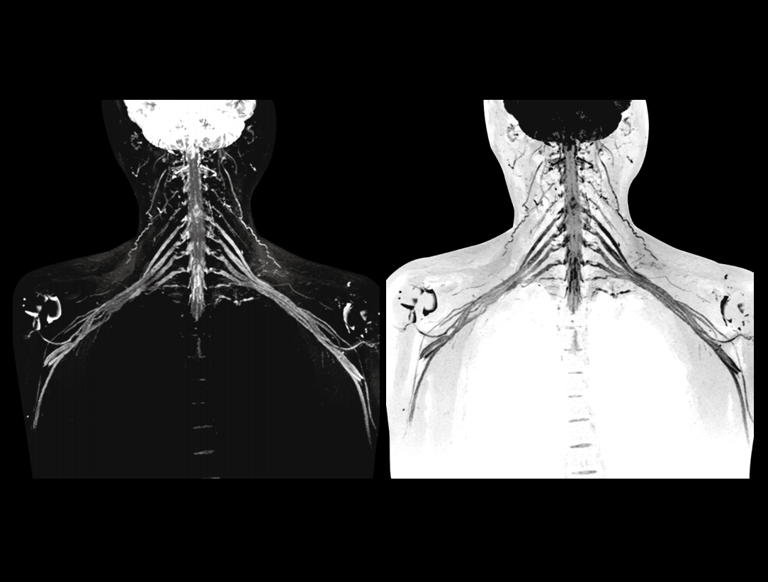 Obrazowanie splotu ramiennego