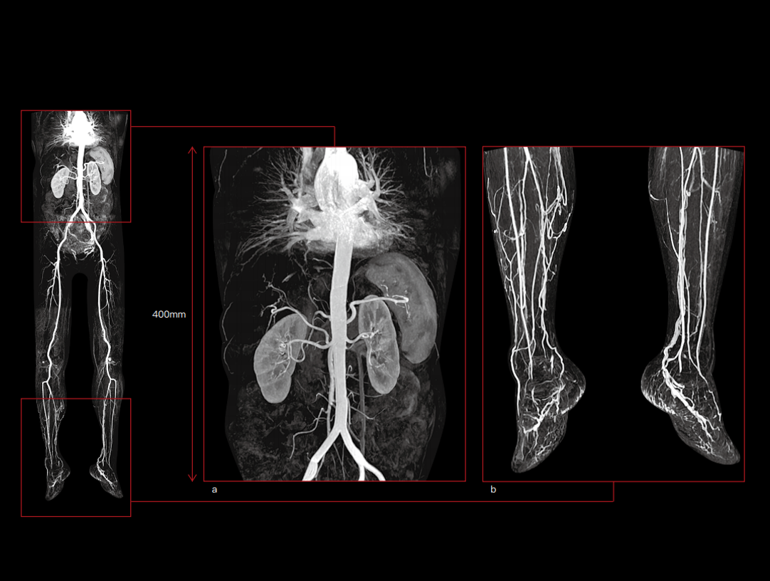 Angiografia MR z kontrastem tętnic tułowia i kończyn dolnych