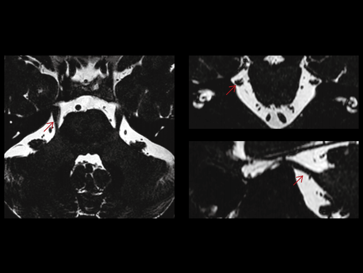 Obrazowanie nerwu trójdzielnego z porównaniem